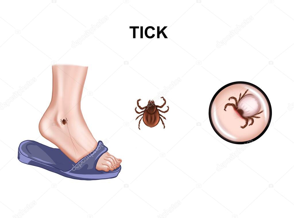 Illustration of the tick-borne encephalitis virus. Tick bite