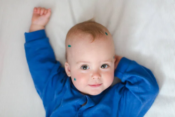 赤ちゃんのベッドの上の水痘 — ストック写真