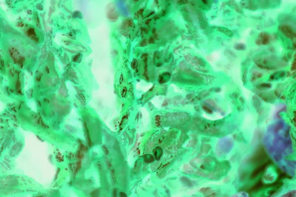 PC-3 células cancerosas da próstata humana coradas com azul Coomassie, un — Fotografia de Stock