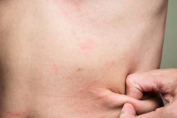 Problem zdrowia wysypka alergii skóry człowieka. — Zdjęcie stockowe