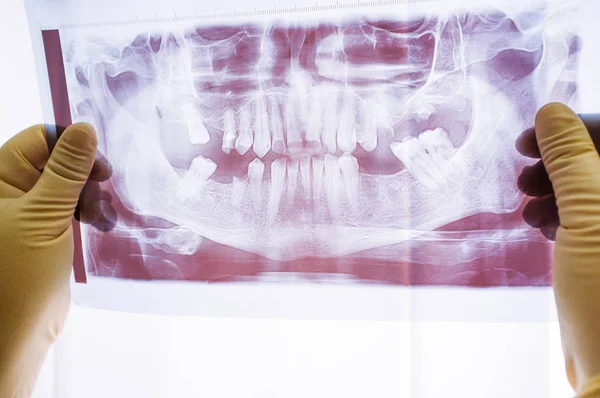 Radiografía dental con problemas de periodontitis —  Fotos de Stock