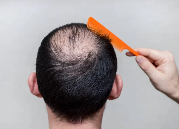 Cabeça masculina com queda de cabelo ou alopecia — Fotografia de Stock