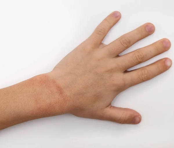 Manchas rojas en la piel de las manos del niño cubiertas con crema de humedad. La causa es el frío del invierno y las condiciones del viento. Fondo gris claro . — Foto de Stock