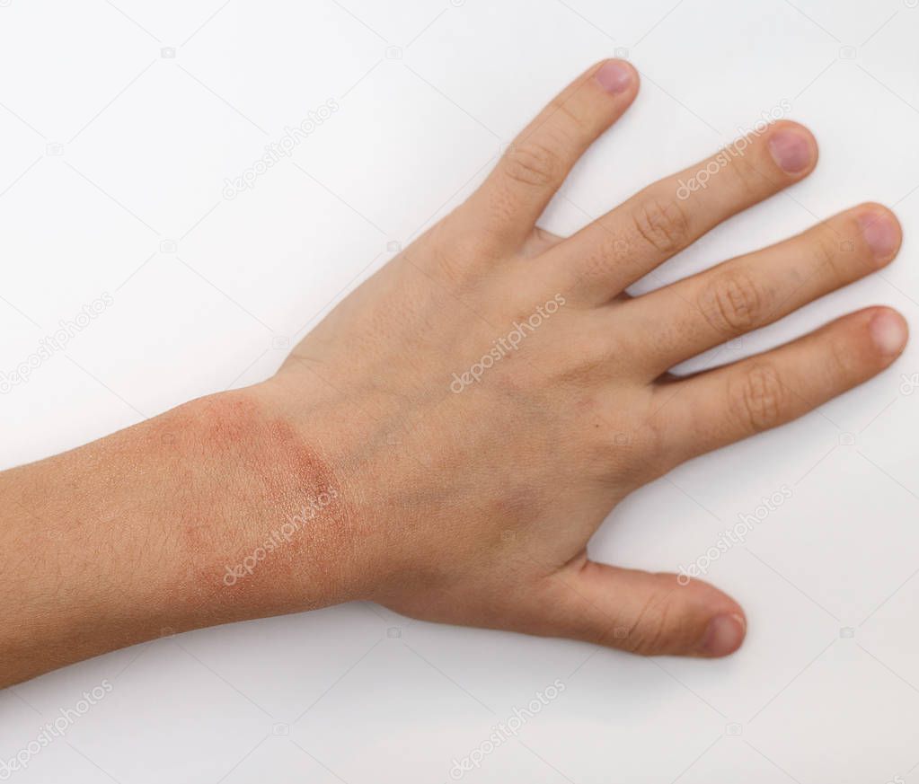 Red spots on child hands skin covered with moisture cream ...