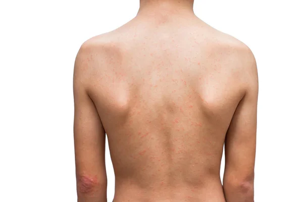 Niño Con Dermatitis Problema Erupción Erupción Alérgica Cuerpo — Foto de Stock