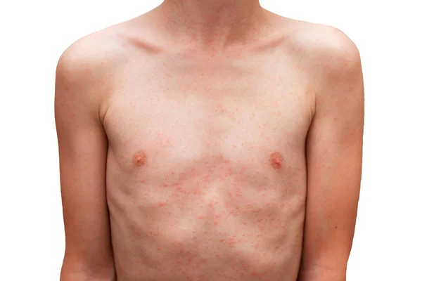 çocuk onun vücudunda kızarıklık, Anti döküntü Dermatit sorunu ile.