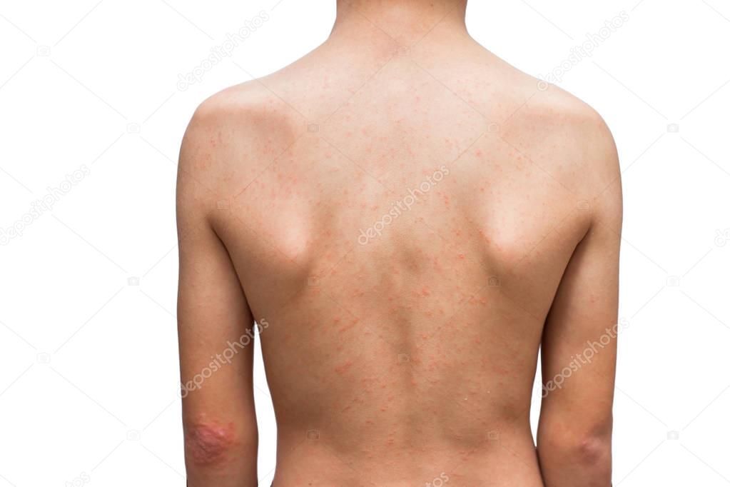 child with dermatitis problem of rash, Allergy rash on his body.
