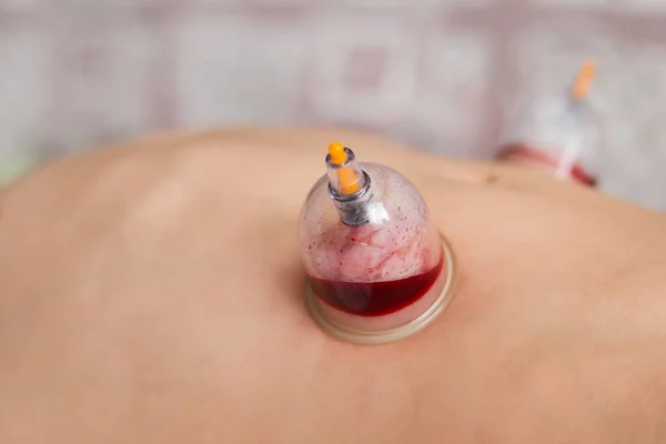 Hijama - derramamiento de sangre. Medicina alternativa . — Foto de Stock