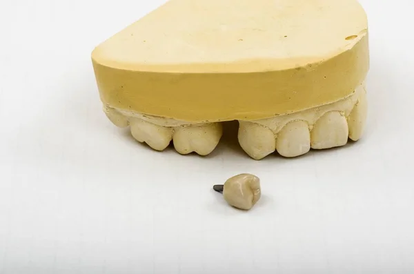 Imagem Uma Impressão Dentária Implante Coroa Pronto Para Montagem Uma — Fotografia de Stock