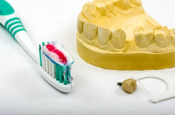 Imagen Una Impresión Dental Implante Corona Listo Para Colocación Toma — Foto de Stock