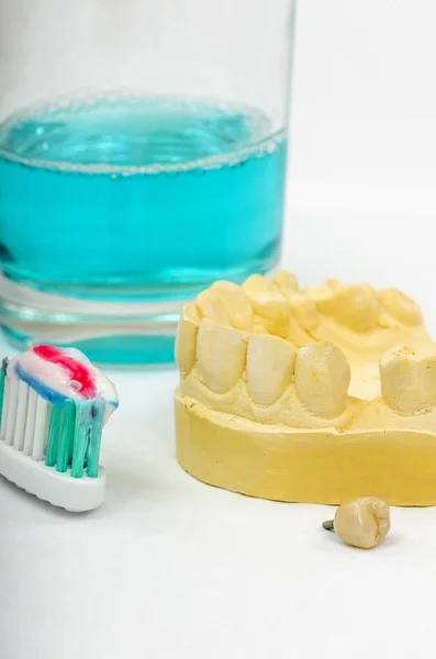 Imagen Una Impresión Dental Implante Corona Listo Para Colocación Toma — Foto de Stock