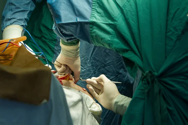 Operazione di trafilatura del cranio . — Foto Stock