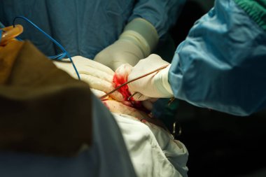 Trepanasyon kafatası işleyişi.