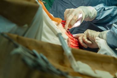 malign bir tümör çıkarılması