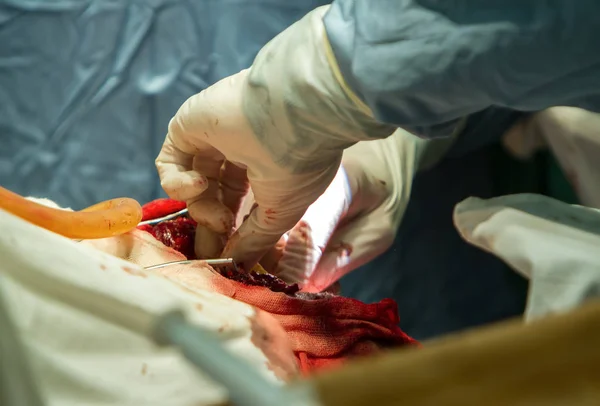 Remoção de um tumor maligno — Fotografia de Stock