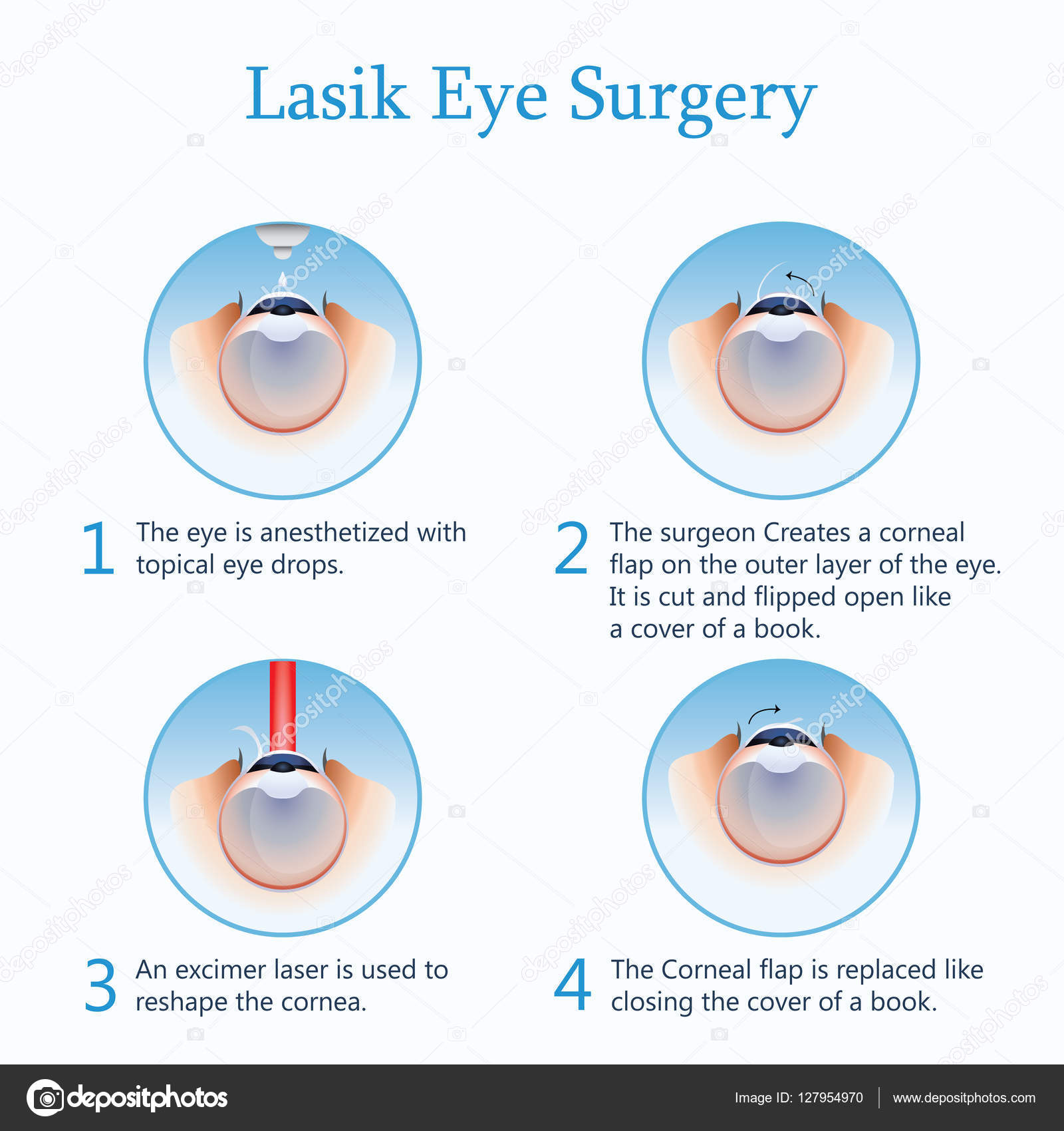 Lasik eye surgery. Vector Illustration Stock Vector Image by ©  #127954970
