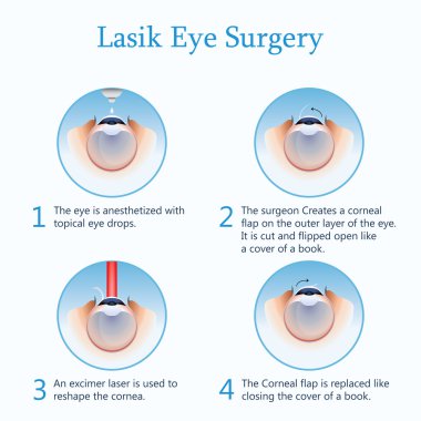 Lasik Göz Cerrahisi. Vektör çizim
