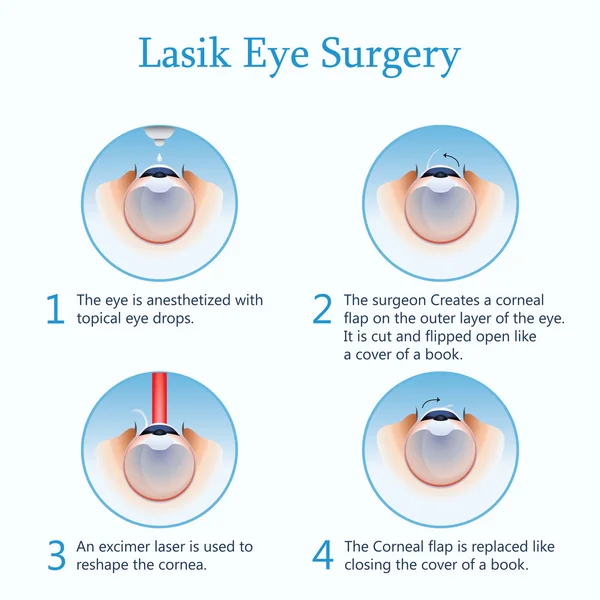 Cirugía ocular Lasik. Ilustración vectorial — Archivo Imágenes Vectoriales