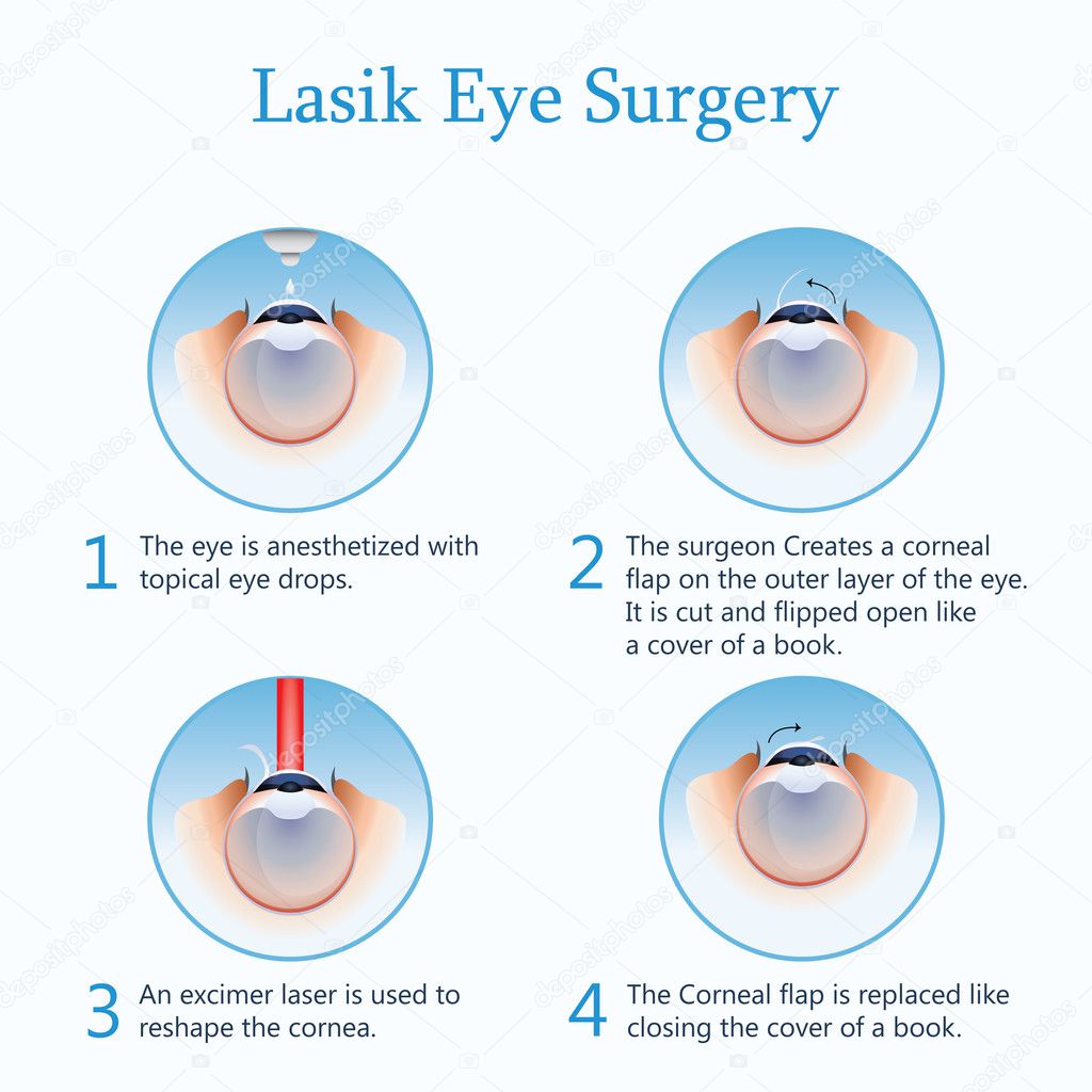 Lasik eye surgery. Vector Illustration - 100% Vector - EPS 10 - Jpg 5000 ps x 5000 px (300dpi) - science - healthcare