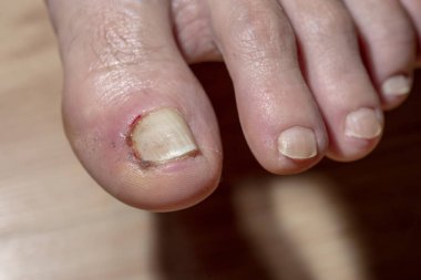 Tırnak iltihabı. hastalık ve yaralanma