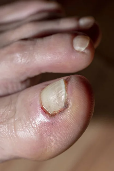 Entzündung Des Nagels Krankheit Und Verletzung — Stockfoto