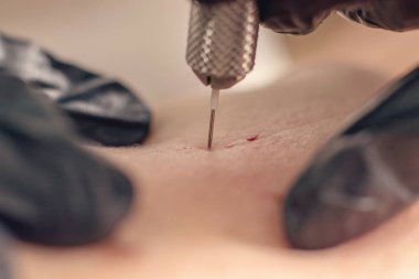 İğne kırışıklık tedavisi. İğne Mezoterapi tek iğne kadar yakın