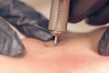 İğne kırışıklık tedavisi. İğne Mezoterapi tek iğne kadar yakın