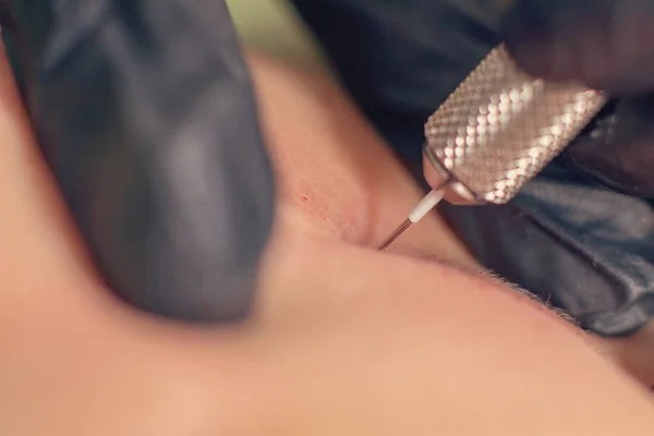 Needle wrinkle treatment. Needle Mesotherapy Single needle Close up — Stock Photo, Image