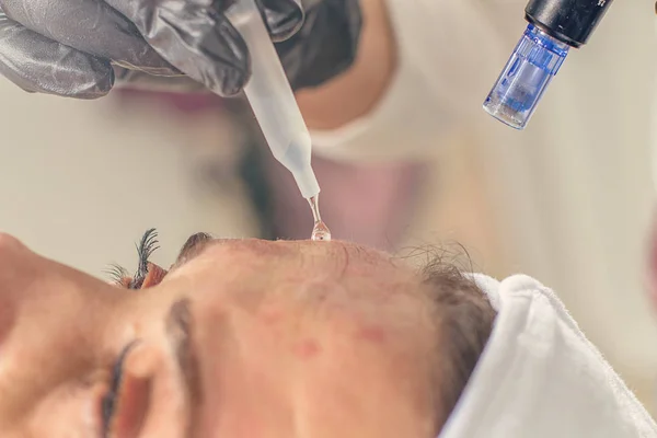 Naald Mesotherapie behandeling op het gezicht van een vrouw. — Stockfoto