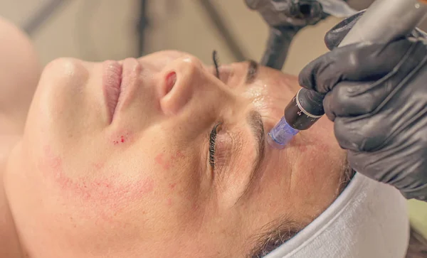 Mezoterápia kezelés tű egy nő arcán. — Stock Fotó