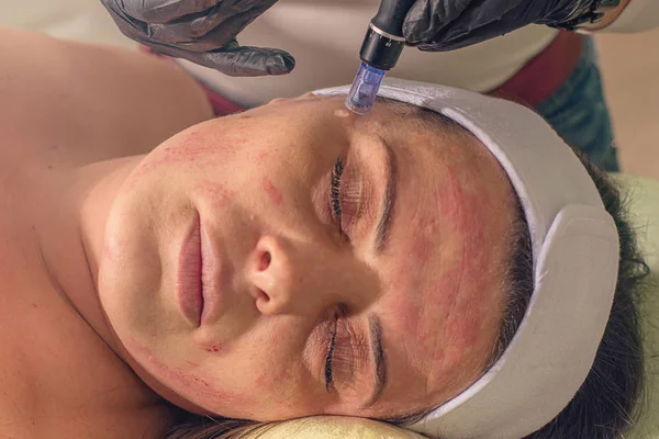 Bir kadın yüzüne iğne Mezoterapi tedavisi. 