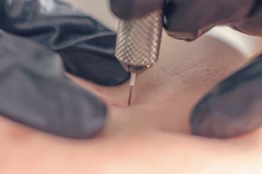 İğne kırışıklık tedavisi. İğne Mezoterapisi Tek iğne Klops