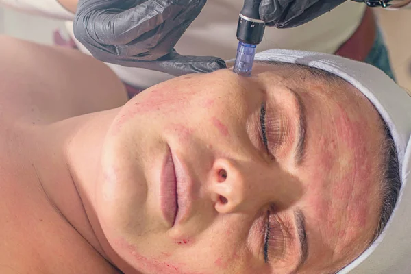 Needle mesotherapy treatment on a woman face.