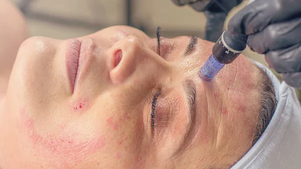 Tratamiento de la mesoterapia con aguja en la cara de una mujer . — Foto de Stock