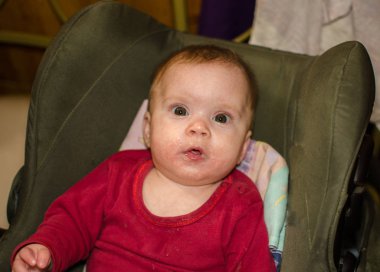 bir çocuk alerji bir sandalyede oturuyor yanaklarda ile