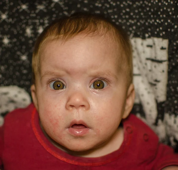 Een kind met een ernstige allergie voor Sheki closeup — Stockfoto