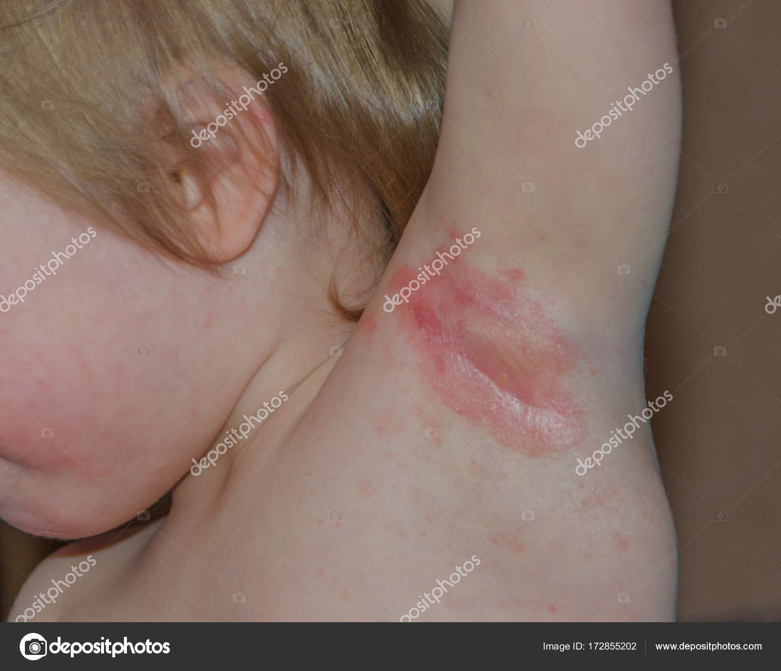 Close-up do bebê na axila inflamação fotos, imagens de © P-KDmitry  #172855202