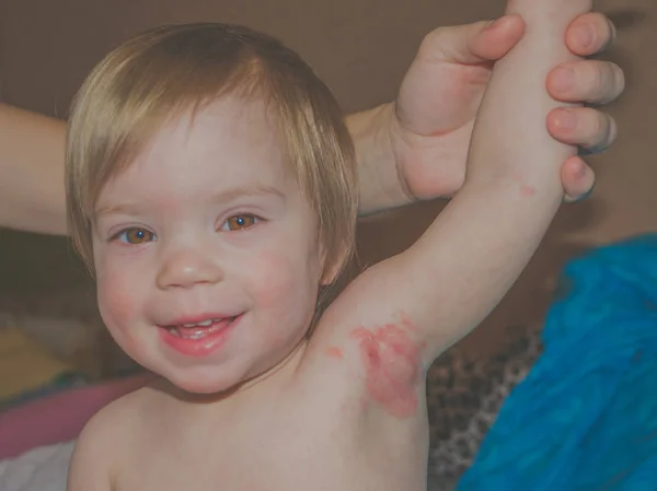 Alergia en niños en la axila — Foto de Stock