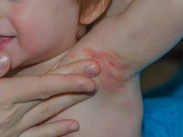 Primer plano de la alergia en los niños en la axila, mamá frota la cura — Foto de Stock