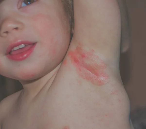 Close-up van allergie bij kinderen in de oksel — Stockfoto