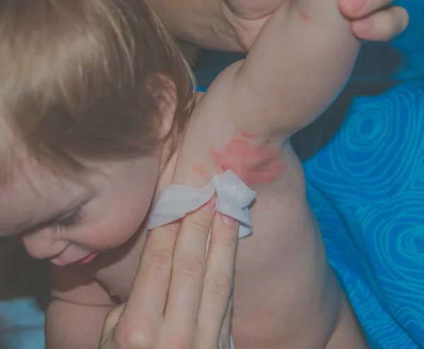 Mamá frota las alergias en los niños en la axila — Foto de Stock