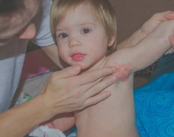 Mamá frota el medicamento en alergias en niños en la axila — Foto de Stock