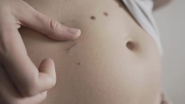 Femme dans un t-shirt blanc caresse son ventre avec des rayures sur la peau . — Video