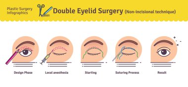 Vector Illustrated set with double eyelid surgery. Non-incisional technique clipart