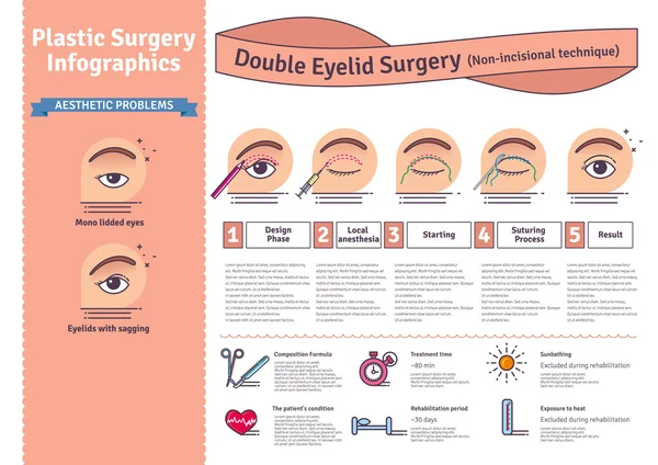 Vector Illustrated ditetapkan dengan operasi kelopak mata ganda. Teknik non-incisional - Stok Vektor