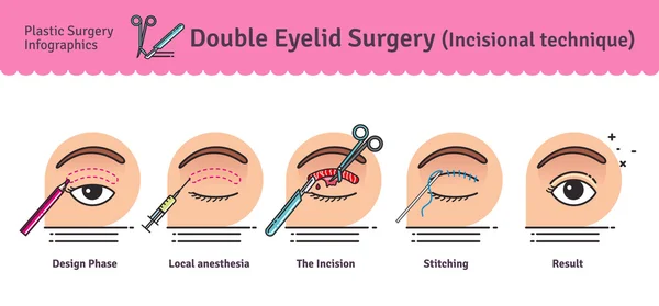 Vektör Illustrated çift göz kapağı cerrahisi ile ayarla