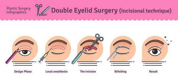 Conjunto ilustrado vetorial com cirurgia de pálpebra dupla —  Vetores de Stock