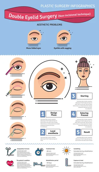 Vector Illustrated ditetapkan dengan operasi kelopak mata ganda. Teknik non-incisional - Stok Vektor