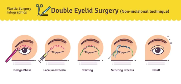 Vector Illustrated set with double eyelid surgery. Non-incisional technique — Stock Vector