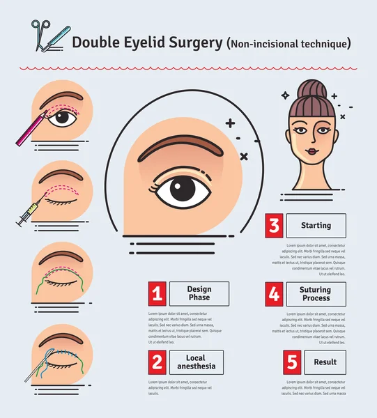 Vector Illustrated set met dubbele ooglid chirurgie. Non-incisional techniek — Stockvector